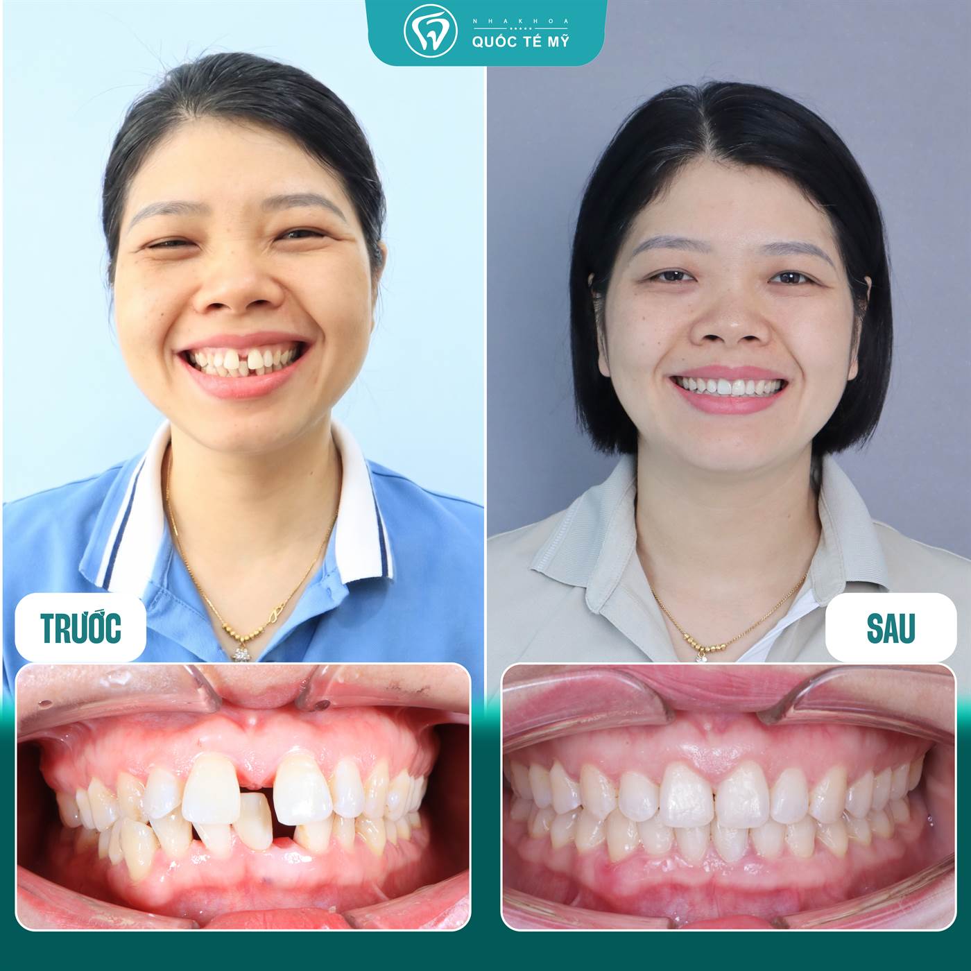 Kết quả trước và sau chỉnh nha — khép khe thưa