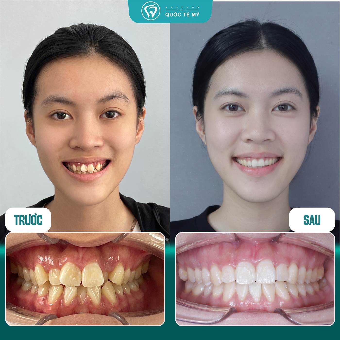 Kết quả trước và sau chỉnh nha — khấp khểnh