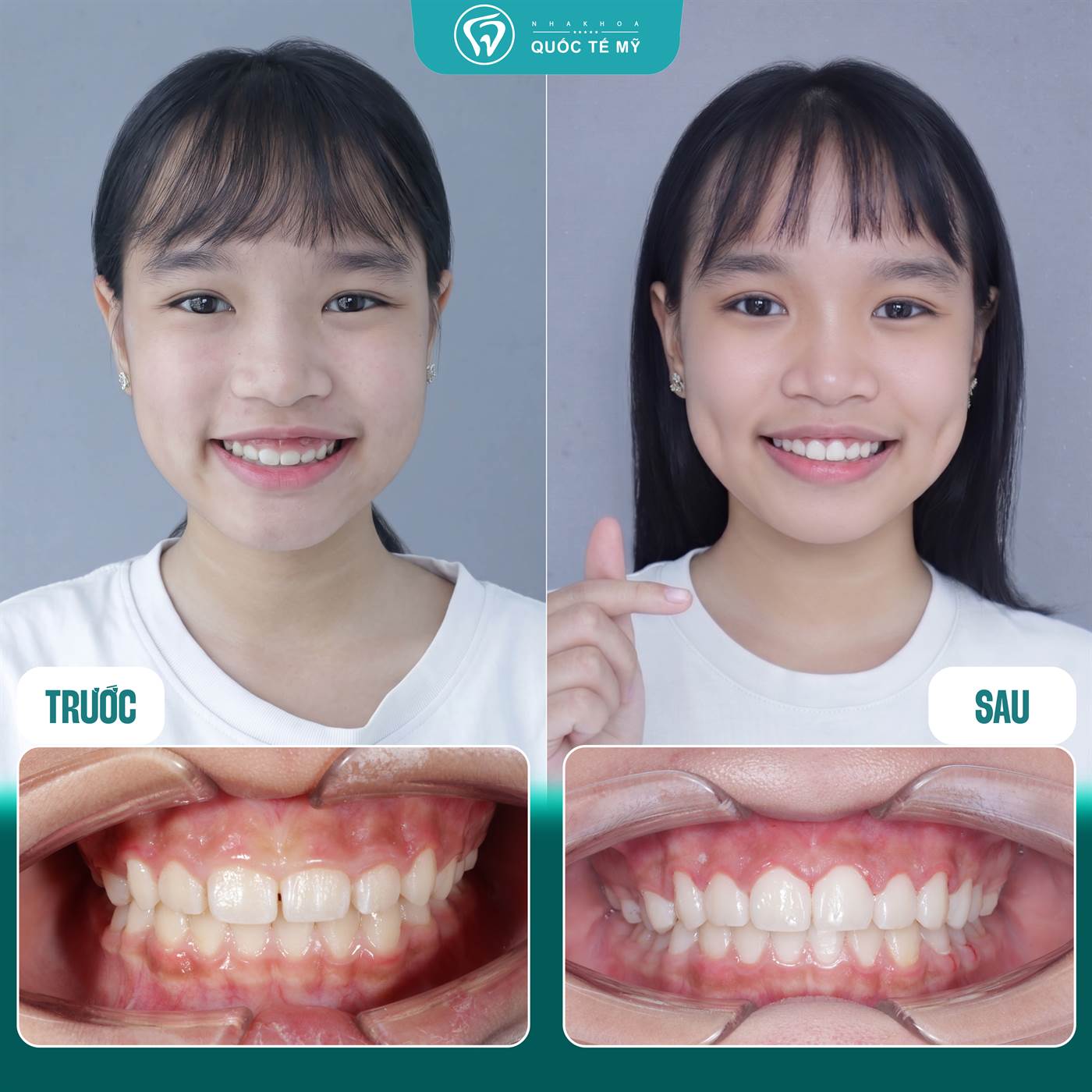 Kết quả trước và sau chỉnh nha — khép khe răng cửa